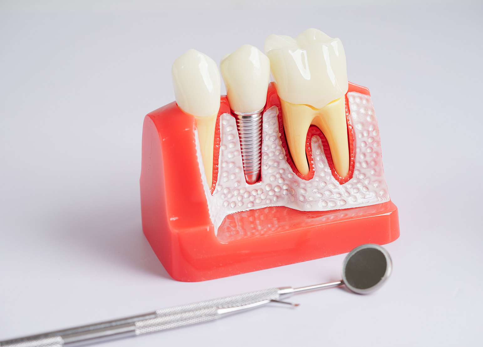 Dental implants with post, abutment, and crown restoring missing teeth