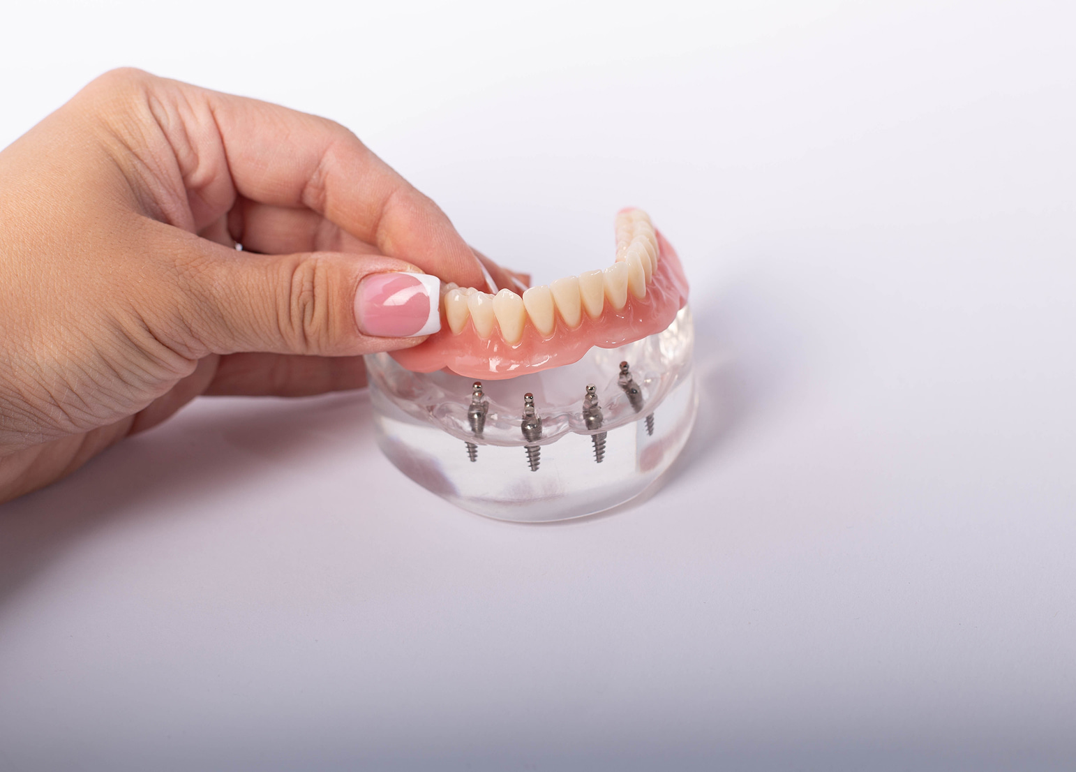 Stable implant-supported removable dentures