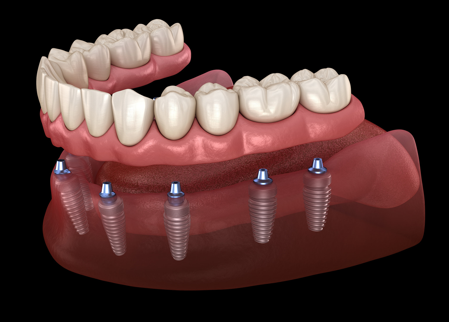 Custom natural-looking implant overdentures at Dental Care of Sterling